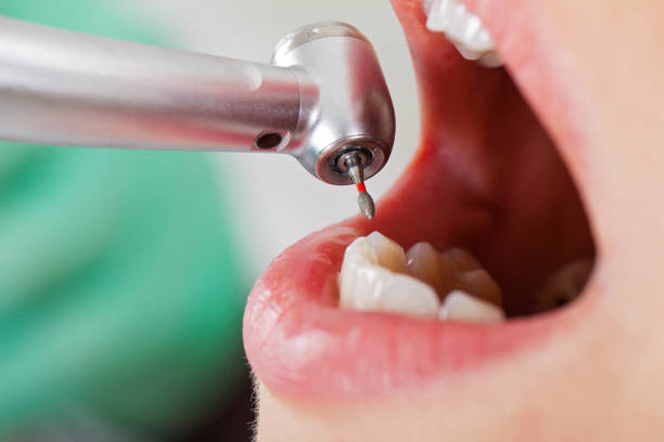 Best Broken Tooth Emergency  in Leesville, LA